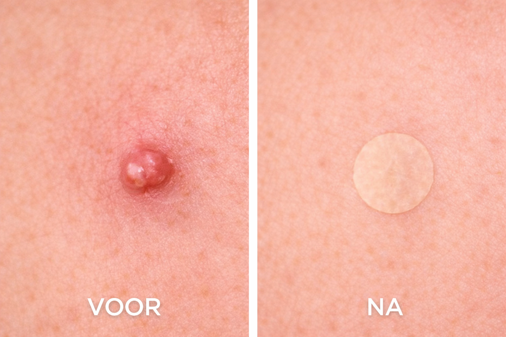 voor en na huid met puistje behandeld met acne patches zichtbaar minder roodheid