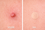 voor en na huid met puistje behandeld met acne patches zichtbaar minder roodheid