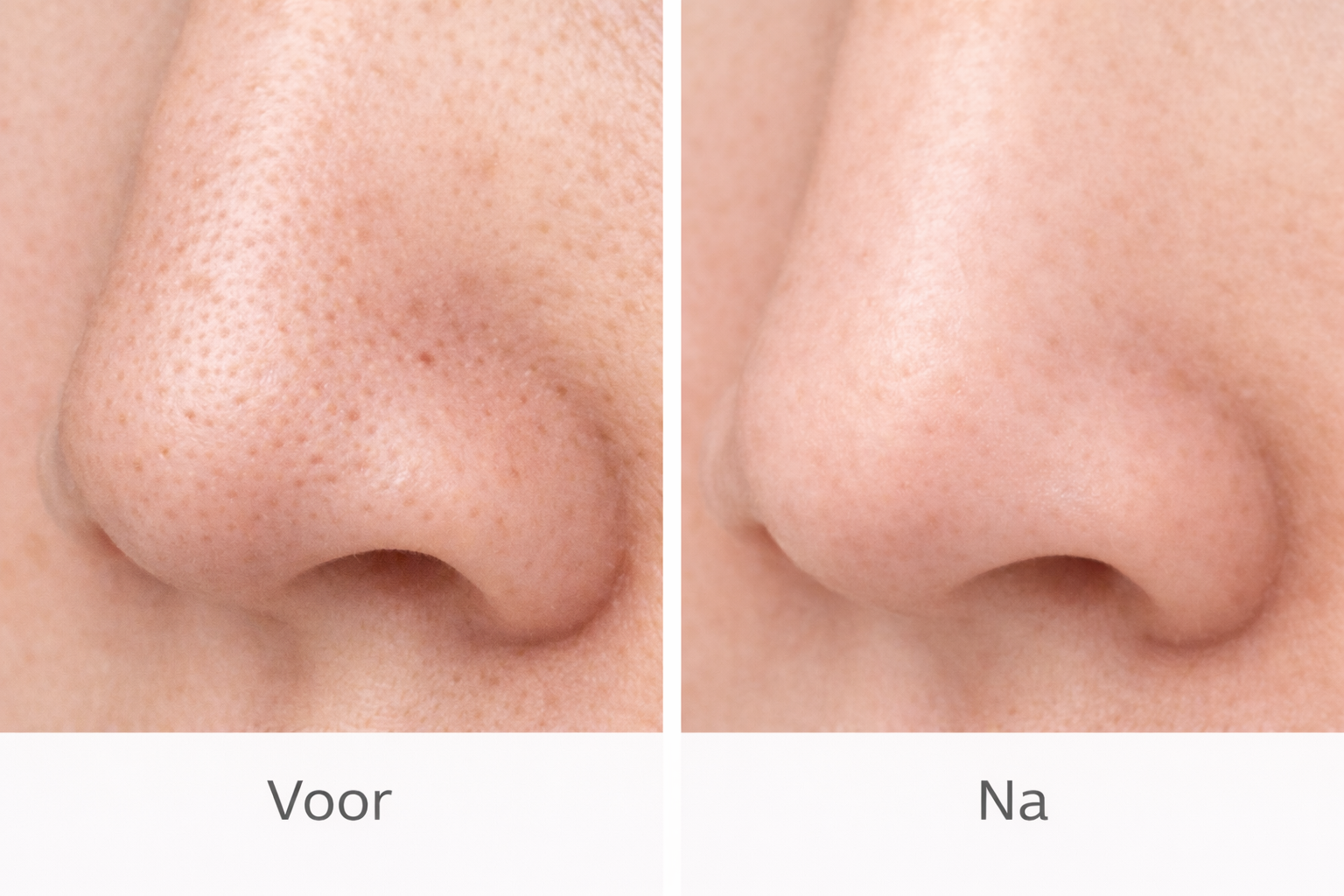 voor en na resultaat huid na gebruik mee eter verwijderaar met schonere poriën